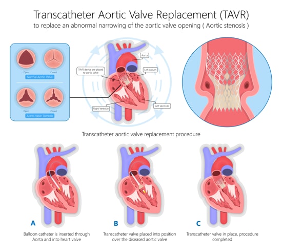 transcatheter aortic valve replacement